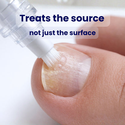 Nooz Antifungal Pen - Nooz