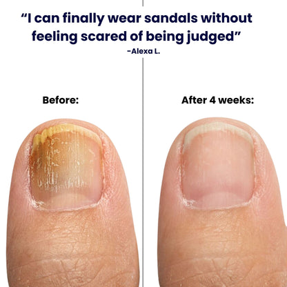 Nooz Antifungal Pen - Nooz