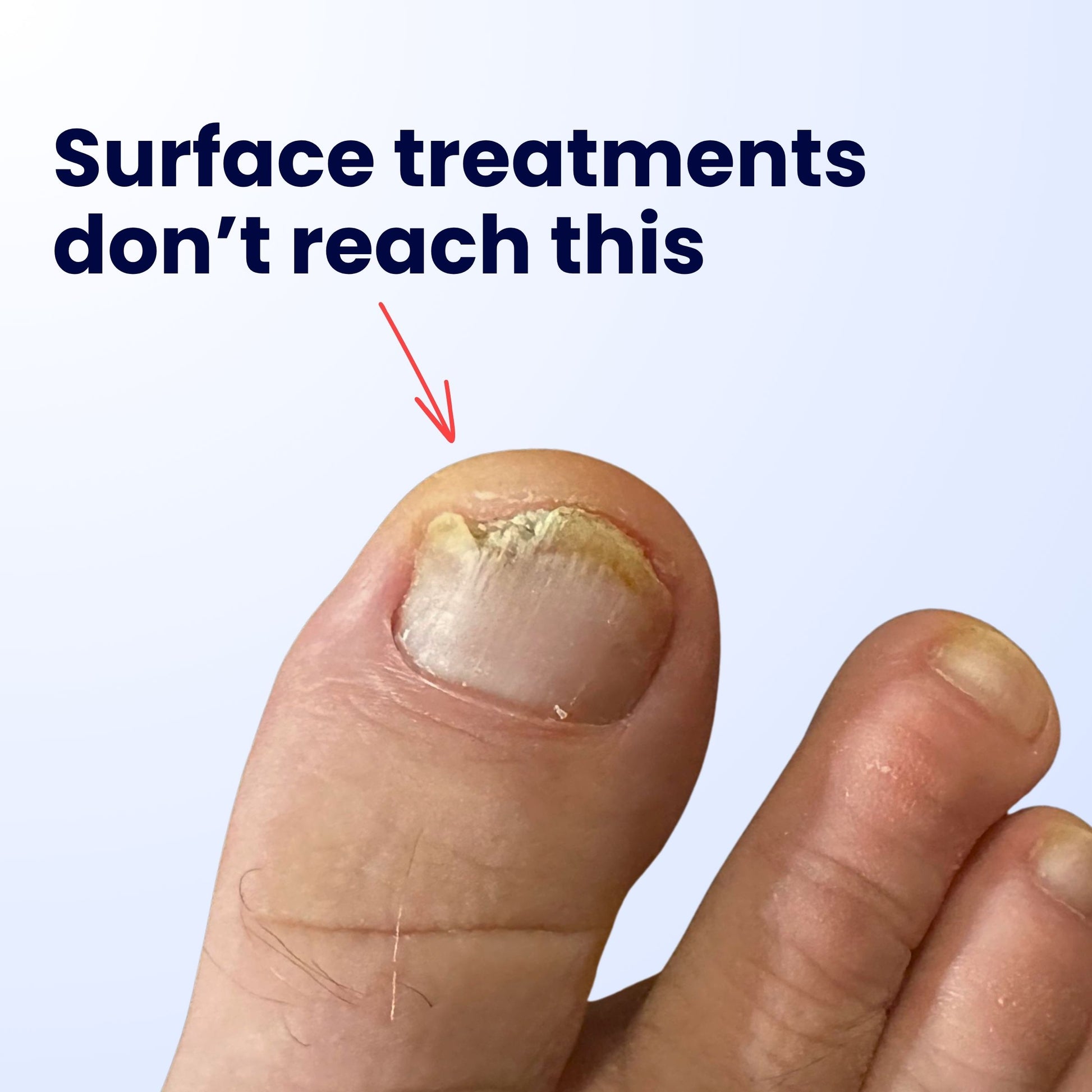 Nooz Antifungal Pen - Nooz