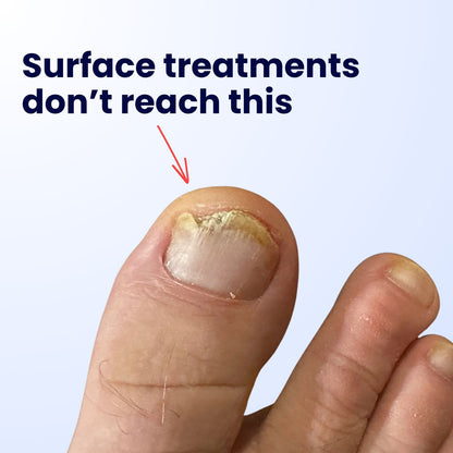 Nooz Antifungal Pen - Nooz